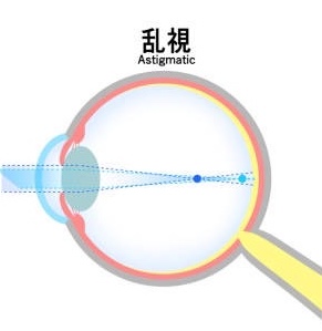 icl 屈折矯正