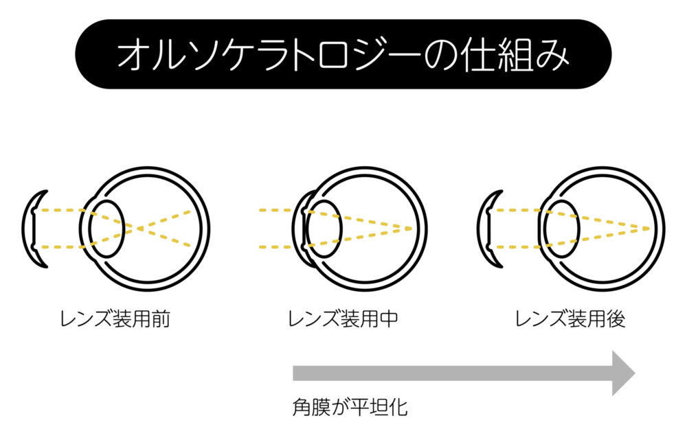 オルソケラトロジーとは