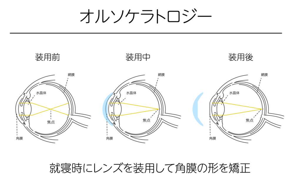 オルソケラトロジーとは