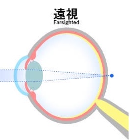 icl 屈折矯正