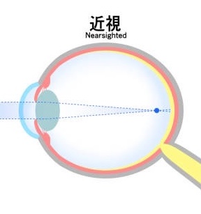 icl 屈折矯正