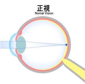 icl 屈折矯正